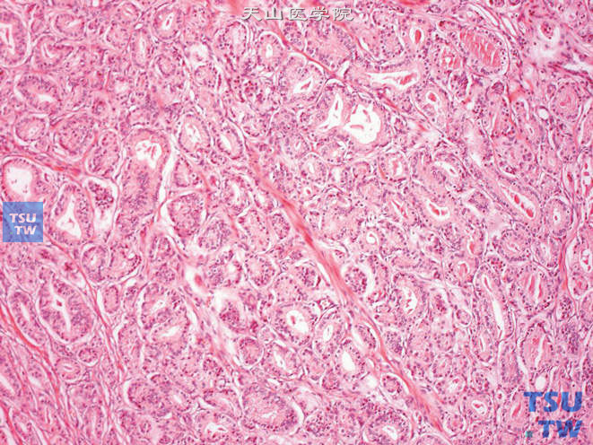 前列腺腺腺癌，Gleason3级，腺体大小不等，形态各异。大部分腺体较小，但也可看到大的不规则腺体。每个腺体均可看到腺腔