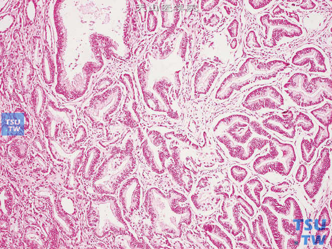 前列腺腺癌，Gleason 3A级。可见长或宽大的腺体，部分腺体可形成拐角。腺体平均中等大小