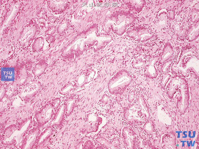 前列腺腺癌，Gleason 3A级。腺体较2级更分散，多形性更明显。某些腺体或长、或宽大，可形成拐角。腺体平均中等大小