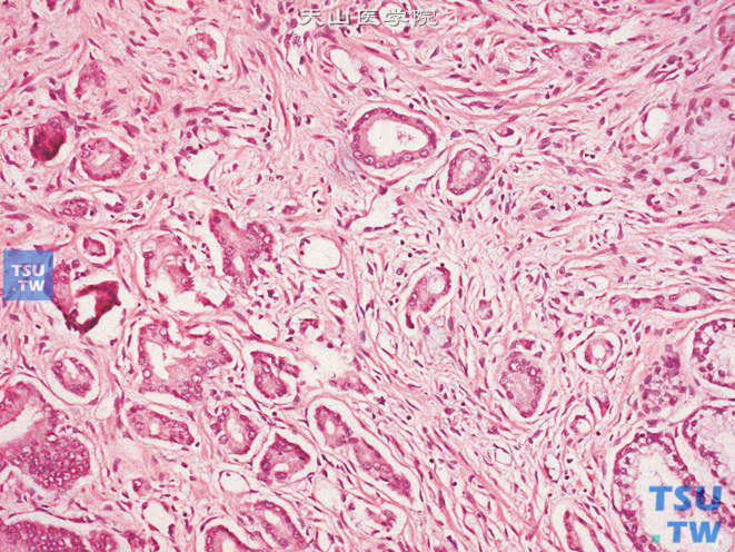 前列腺腺癌，Gleason 3B级。腺体较3A级小，甚至有3～5个细胞构成的小腺体，形态不规则