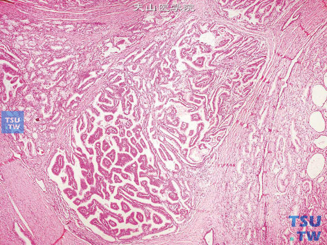 前列腺腺癌，Gleason 3C级。肿瘤由乳头状或筛状巢块构成，与4级癌相比，其边缘光滑，无不整齐的浸润