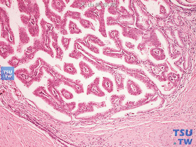 前列腺腺癌，Gleason 3C级。上图高倍。示癌巢边缘整齐，无不规则浸润。癌组织呈乳头状结构