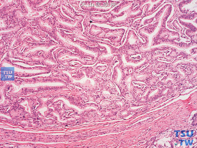 前列腺腺癌，Gleason 3C级。示癌组织呈筛状结构，其边缘光滑，无不整齐的浸润