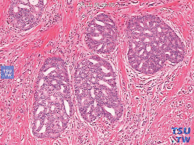 前列腺腺癌，Gleason 3C级。示癌组织呈筛状结构，其边缘光滑