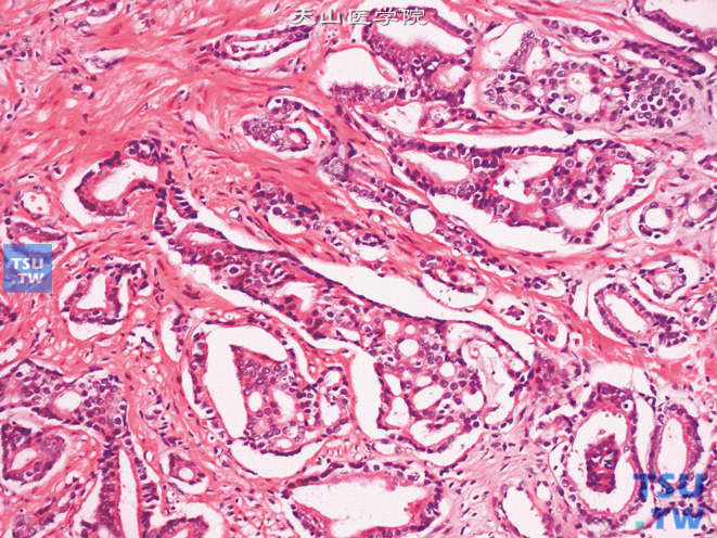 前列腺腺癌，Gleason 4级，示不规则筛状腺体，边缘参差不齐。与融合的腺体不同，筛状腺体中无间质条索。细胞核可见异型性，核仁明显