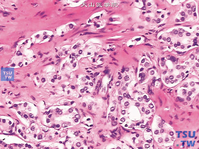 前列腺腺癌，Gleason 4级，微小腺泡型。癌组织由微小腺泡构成，腺泡与腺泡之间可见融合