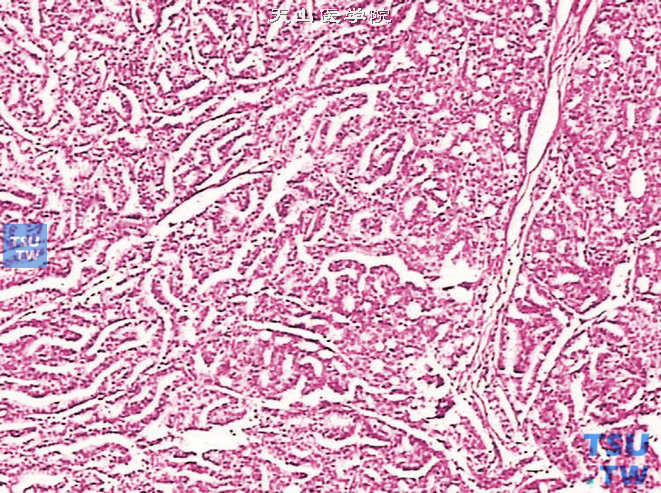前列腺腺癌，Gleason 4级，呈筛状结构，可见腺体融合