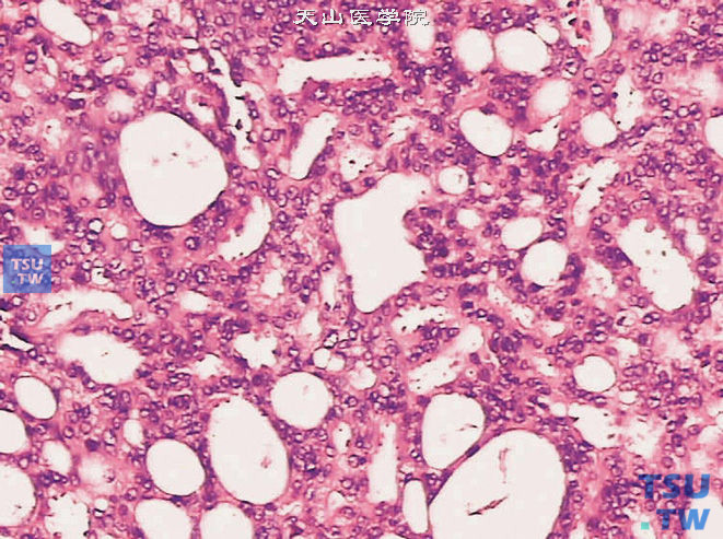 前列腺腺癌，Gleason 4级，示筛状结构中的腺体融合