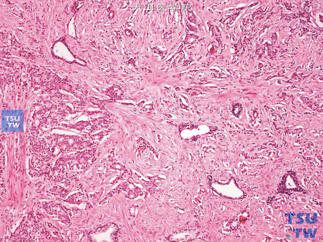 前列腺腺癌，Gleason 4级。腺体呈微小腺泡或筛状结构，与Gleason 3级的前列腺癌不同，4级癌的筛状结构边缘可见浸润性生长，并可见腺体融合