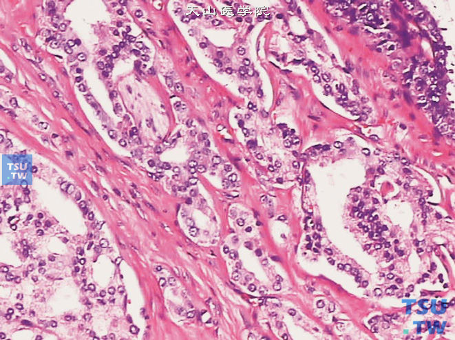 前列腺腺癌，Gleason 4级，侵犯神经。可见筛状的癌组织围绕于神经周围