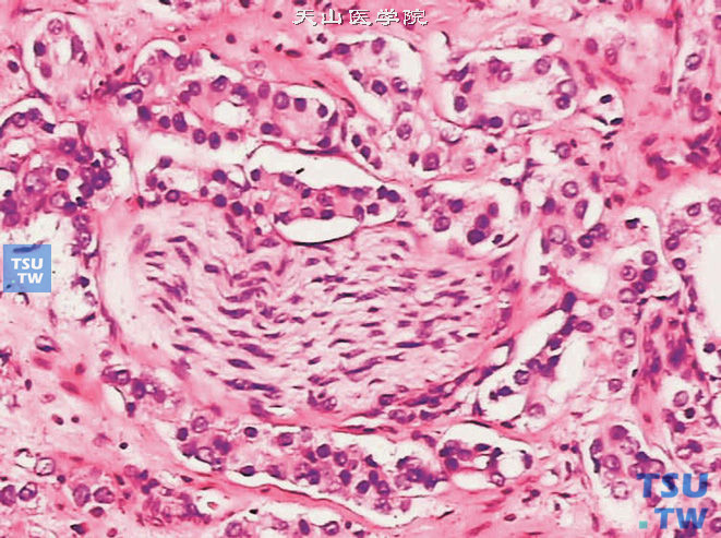 前列腺腺癌，Gleason 4级，侵犯神经，可见融合的小腺体围绕于神经周围