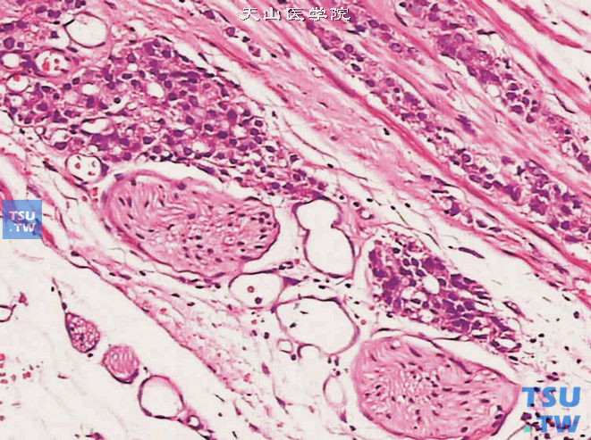 前列腺腺癌，Gleason 4级，可见筛状的癌组织沿神经侵出被膜