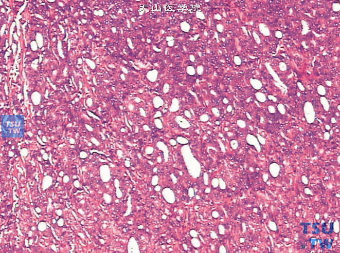 前列腺腺癌，Gleason 4A级，可见由暗细胞构成的筛状结构