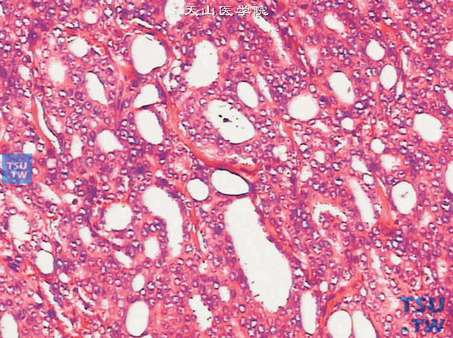 前列腺腺癌，Gleason 4A级，上图高倍，示肿瘤细胞为暗细胞，核仁清晰