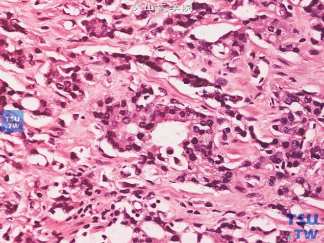 前列腺腺癌，Gleason 4A级。癌组织由暗细胞构成。核仁明显。可见腺体融合