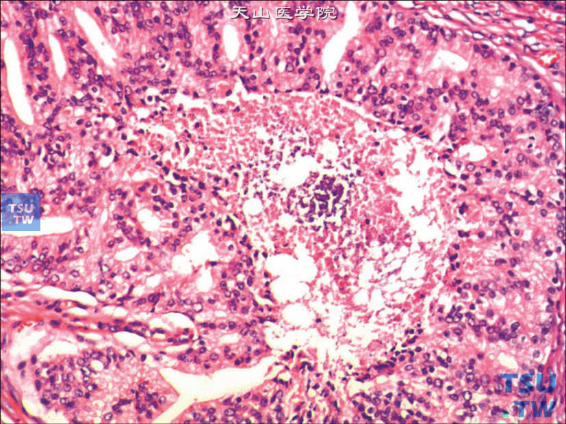前列腺腺癌，Gleason 5A级。于筛状结构的癌组织中央可见坏死，呈粉刺样癌表现
