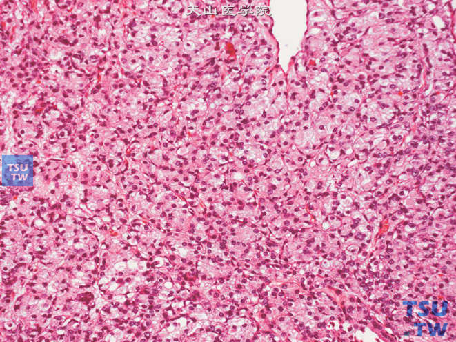 前列腺腺癌，Gleason 5B级。示肿瘤呈实性片状分布，仅偶见腺腔结构