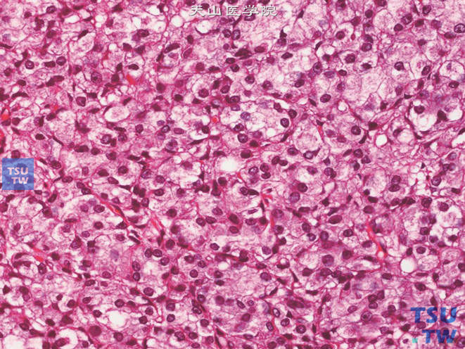 前列腺腺癌，Gleason 5B级。上图高倍。癌组织呈实性片状分布，核仁显著