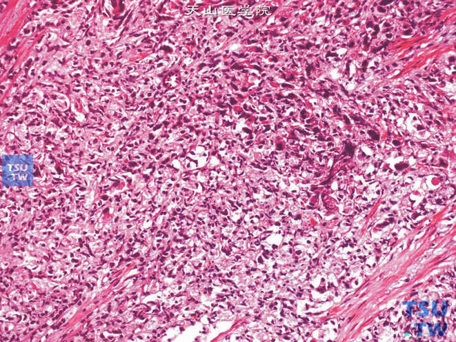 前列腺腺癌，Gleason 5B级。癌组织呈实性片状或条索状结构，浸润生长，周围可见断裂的平滑肌束