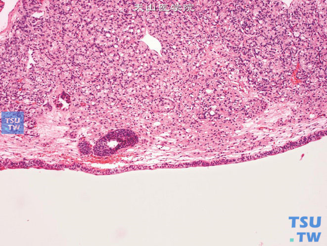 前列腺腺癌，Gleason 5B级。示片状分布的前列腺癌侵犯尿道黏膜