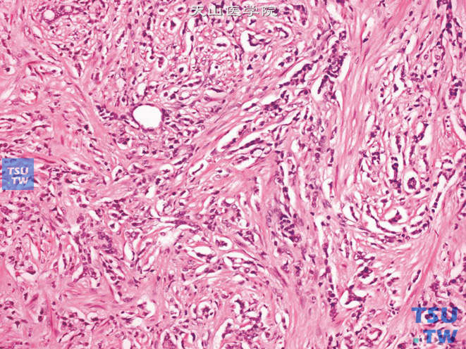 前列腺腺癌，Gleason 5B级。肿瘤细胞呈条索状排列，腺体结构消失，仅偶见腺腔