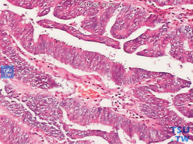 前列腺导管腺癌，肿瘤向尿道或大导管腔内生长，具有特征性的管状结构