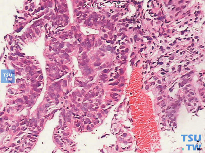 前列腺导管腺癌，肿瘤呈管状结构，上皮呈高柱状，伴坏死