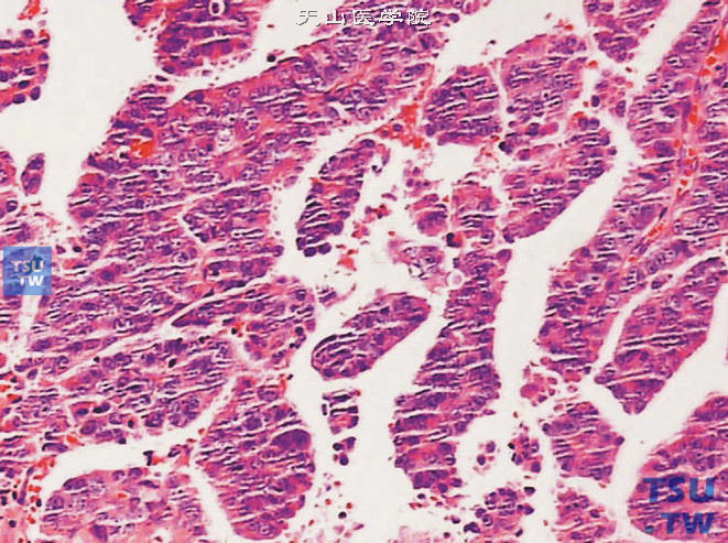 前列腺导管腺癌，肿瘤呈乳头状结构