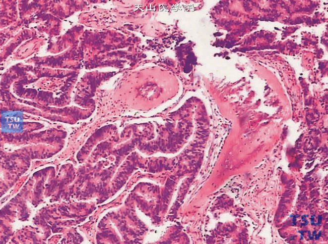 前列腺导管腺癌病理图谱