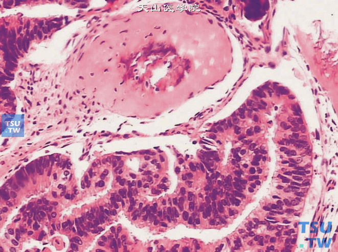 前列腺导管腺癌骨转移，上图高倍，示核分裂象易见