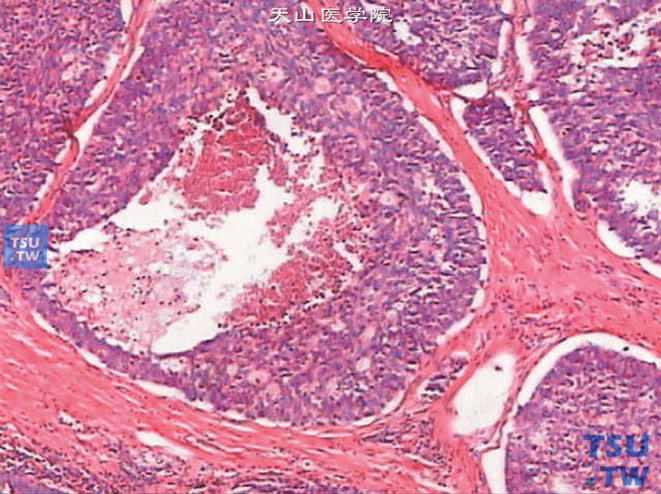 前列腺尿路上皮癌，中央可见坏死