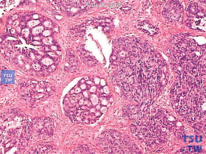 前列腺尿路上皮癌病理图谱
