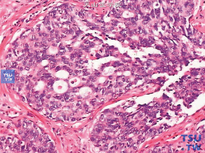 前列腺尿路上皮癌，呈假腺样结构，上图高倍