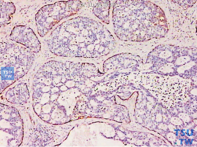 前列腺尿路上皮癌，呈假腺样结构，免疫组化：34βE12（+）