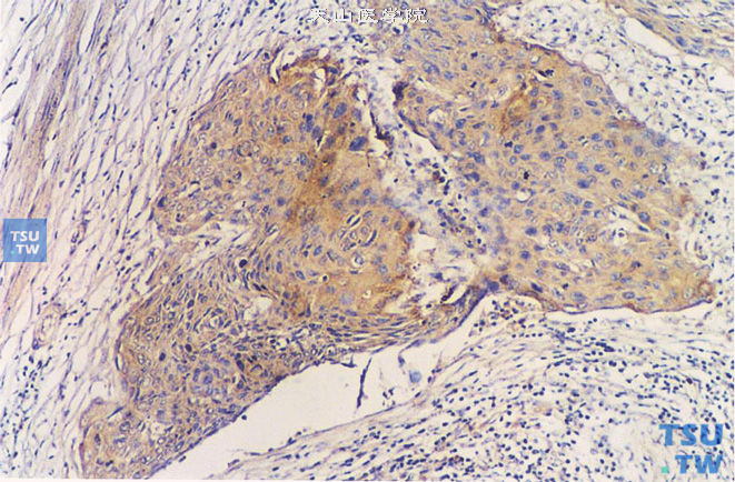 前列腺鳞状细胞癌病理图谱