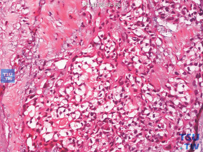 前列腺基底细胞癌。示类似于基底细胞增生的细胞巢，伴浸润性生长