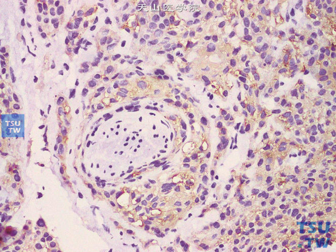 前列腺基底细胞癌病理图谱
