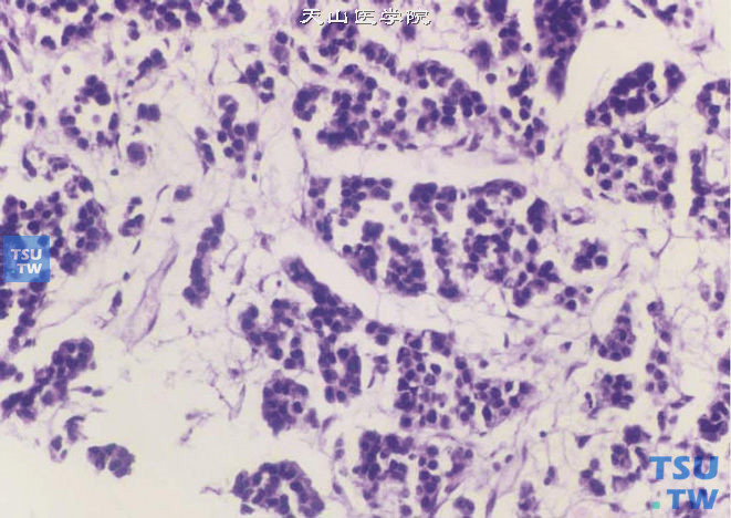前列腺小细胞癌，形态类似于其他部位的小细胞癌