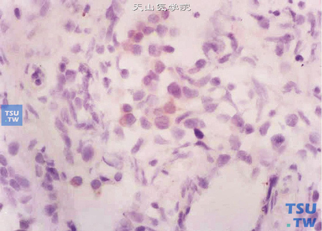 前列腺小细胞癌病理图谱