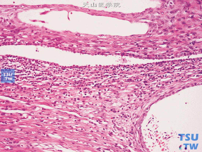 前列腺特异性间质肿瘤，恶性潜能不确定的前列腺间质增生（STUMP）。示上皮细胞呈扁平、立方或钉突状