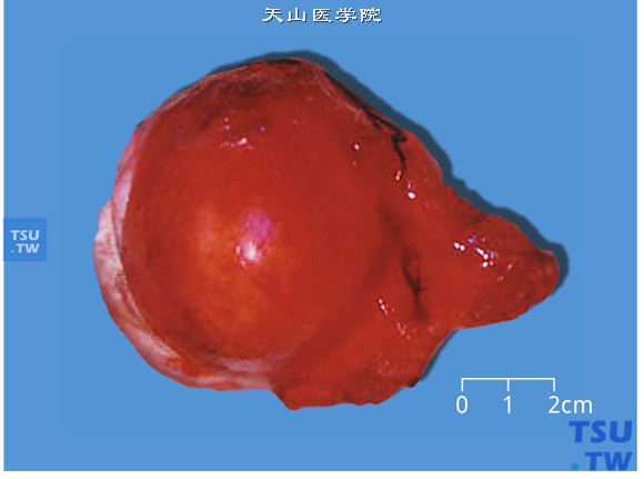 前列腺平滑肌瘤（大体）