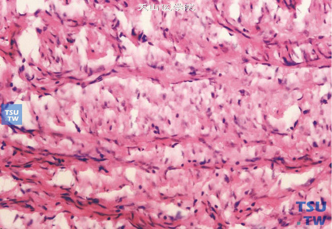 前列腺平滑肌瘤，由增生的平滑肌细胞构成