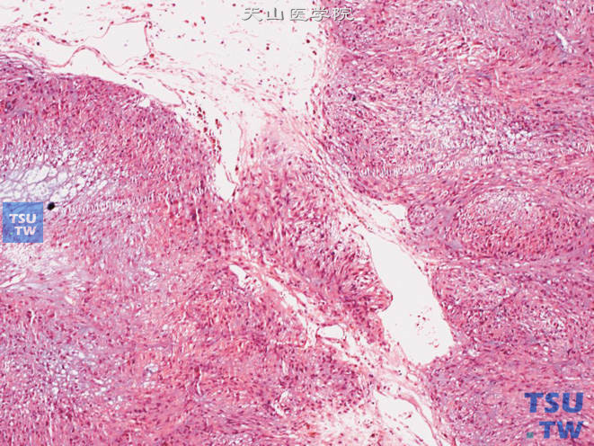 前列腺特异性间质肉瘤，示叶状瘤样生长