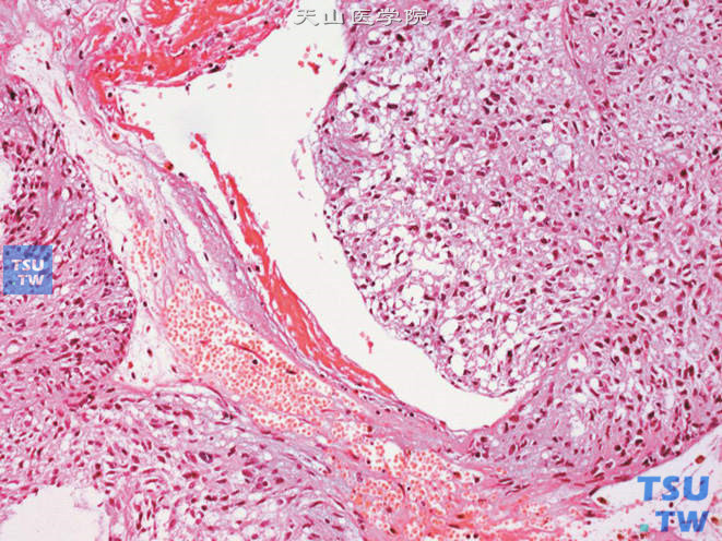 前列腺特异性间质肉瘤，示叶状瘤样生长及明显的异型性
