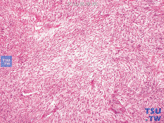 前列腺特异性间质肉瘤，部分区域细胞以梭形为主