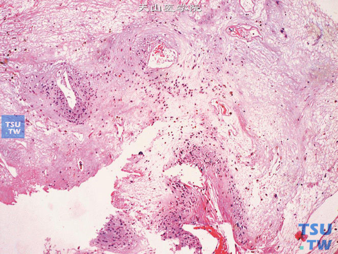 前列腺特异性间质肉瘤，可见坏死