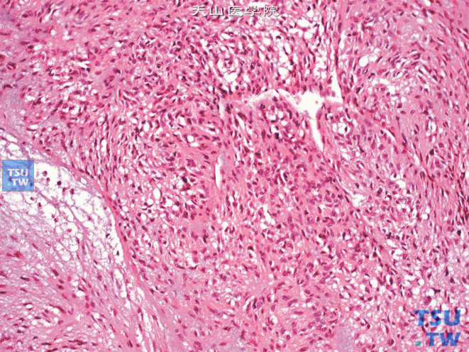 前列腺特异性间质肉瘤，示细胞密集区