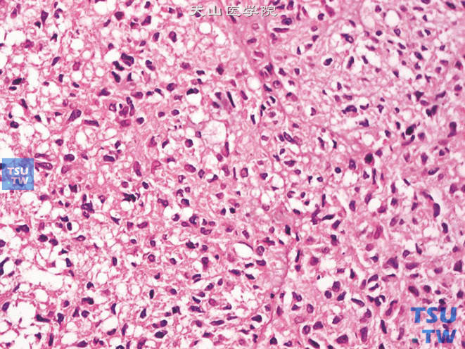 前列腺特异性间质肉瘤，示细胞异型，可见核仁及核分裂象