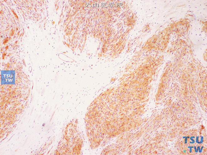 前列腺特异性间质肉瘤，免疫组化：CD34（+）