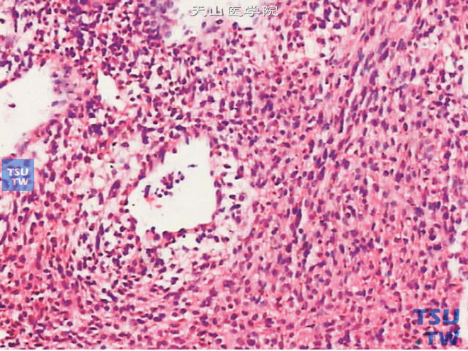 前列腺平滑肌肉瘤，细胞弥漫成片，编织状结构不明显，细胞多形性明显，可为小圆、卵圆、多边形或带状，核浓染